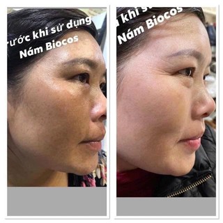 COMBO chăm sóc da NÁM, tàn nhang, thâm mụn…