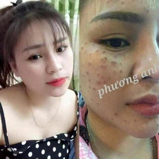 Chấm tàn nhang