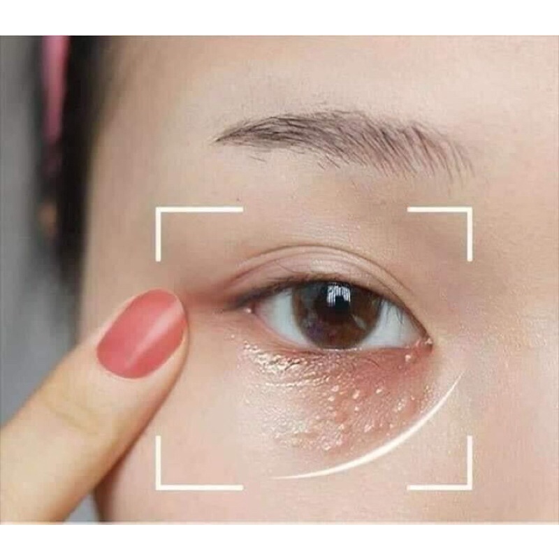 Kem tẩy mụn thịt quanh mắt Tsubuporon nhật bản loại bỏ mụn thịt mụn cơm xóa mụn thịt mụn cơm hiệu quả.