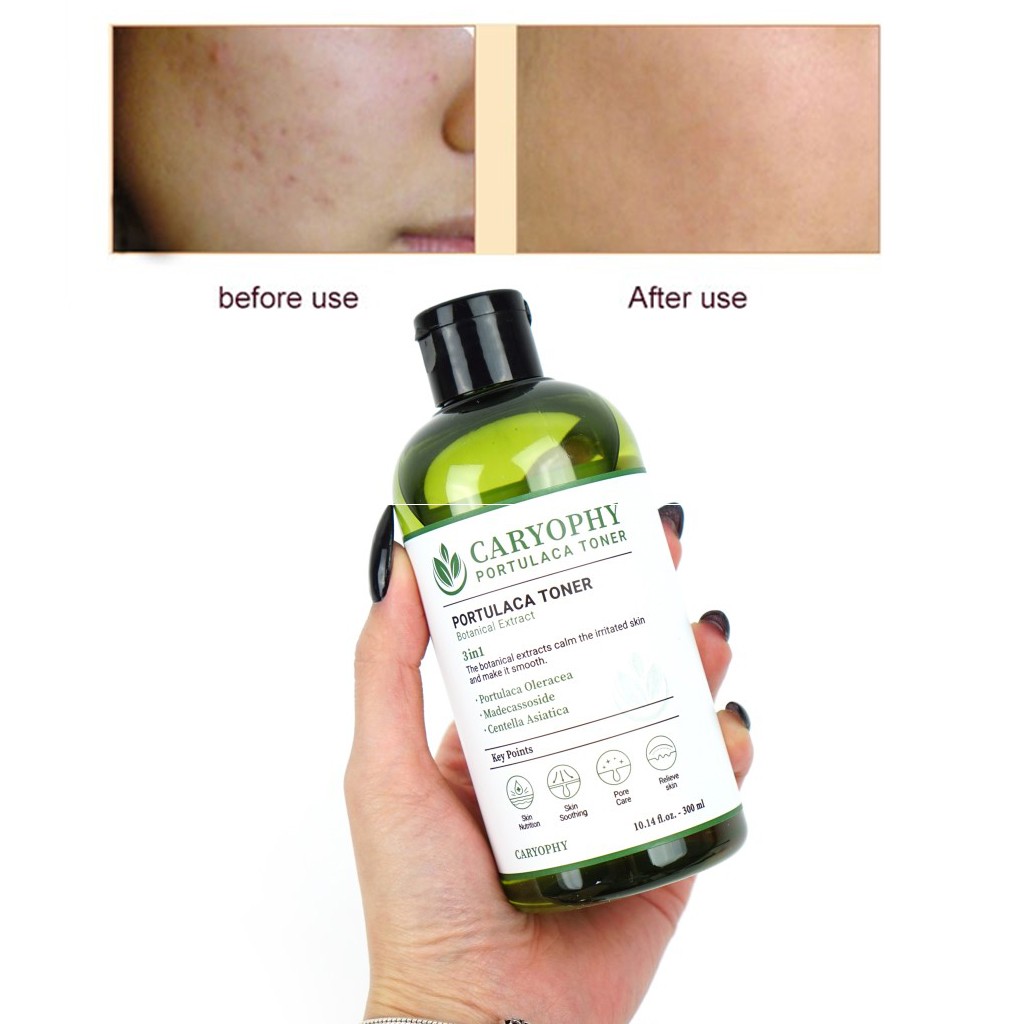 Toner Ngăn Ngừa Mụn Thâm Dành Cho Da Dầu Nhạy Cảm Caryophy Hàn Quốc | BigBuy360 - bigbuy360.vn