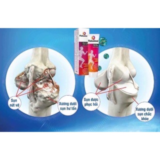 Kem bôi giảm đau nhức xương khớp của Nga