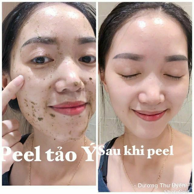 Peel da tảo ý, tách set liệu trình 5 lần, căng bóng, trắng sáng da