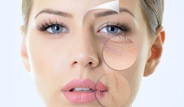 Botox xóa nhăn , chống chảy xệ , trẻ hóa