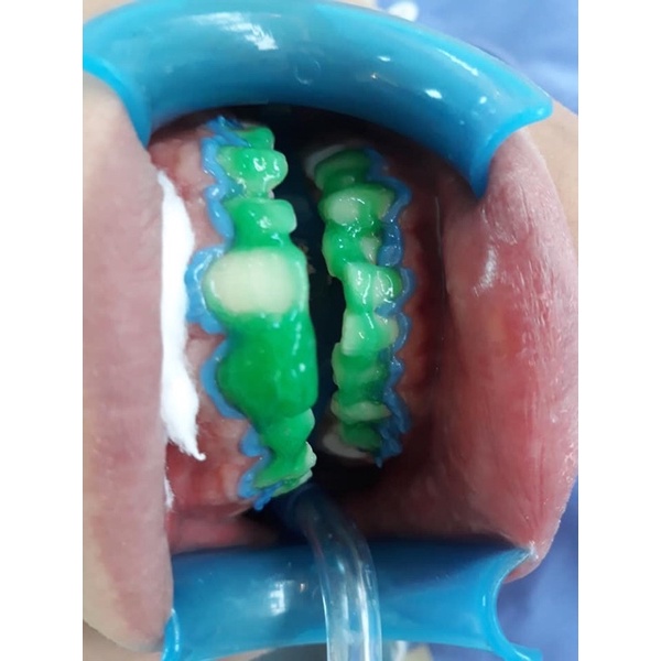 Tẩy trắng,bắn trắng răng hp mã