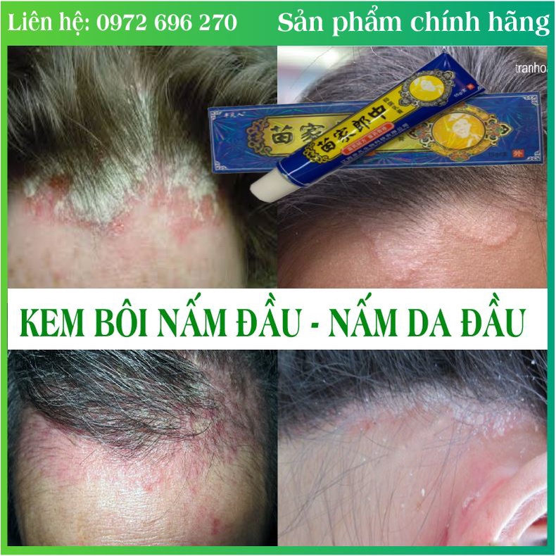 <Xanh> Kem bôi Nấm Đầu - Nấm da đầu Cực hiệu quả ( Hết sạch nấm chỉ với 1 tuýp nhỏ )