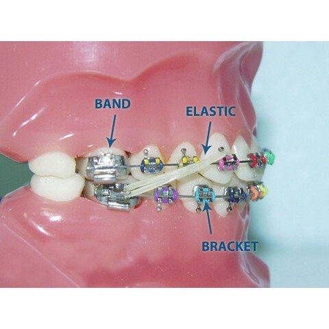 Hộp band  đủ số 17 - 35 chuyên chỉnh nha niềng răng tại nha khoa