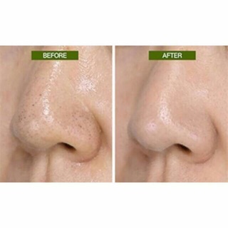 THANH LĂN MỤN ĐẦU ĐEN MAMONDE