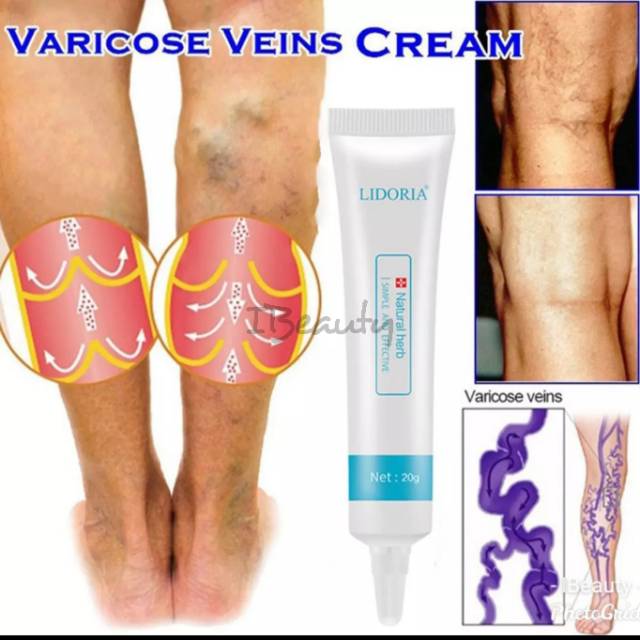 (hàng Mới Về) Kem Dưỡng Da Varises / Spider Veins