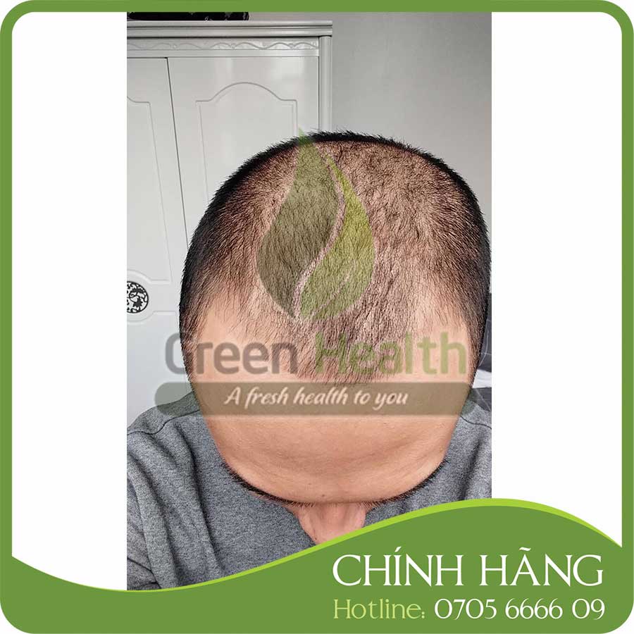 Biotin 10000 Mcg Của Mỹ mọc râu tóc