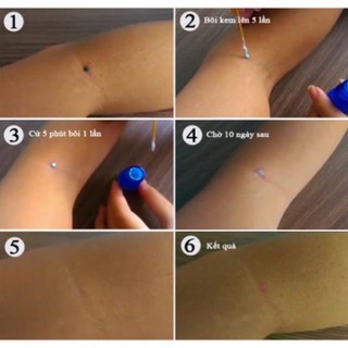 Kem Tẩy Nốt Ruồi Poola 5ml hiệu quả