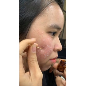 Chấm Nám, Tàn Nhang, Làm Đầy Sẹo Rỗ, Xóa Nốt Ruồi Handmade