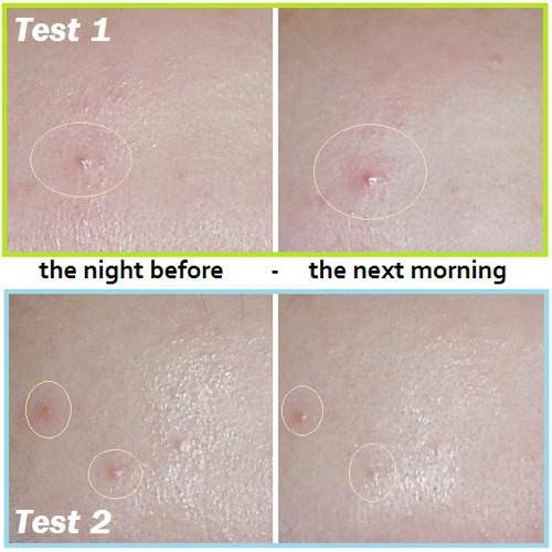 Lịch sử giá Miếng dán mụn acne pimple master patch cập nhật 6/2023 - BeeCost