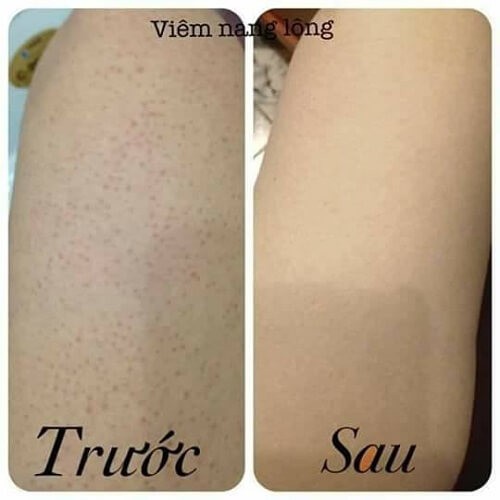 Kem ngừa viêm nang lông Nhật Kobayashi