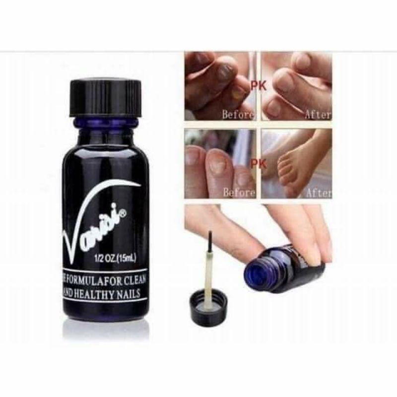 Điều trị nấm móng Varisi