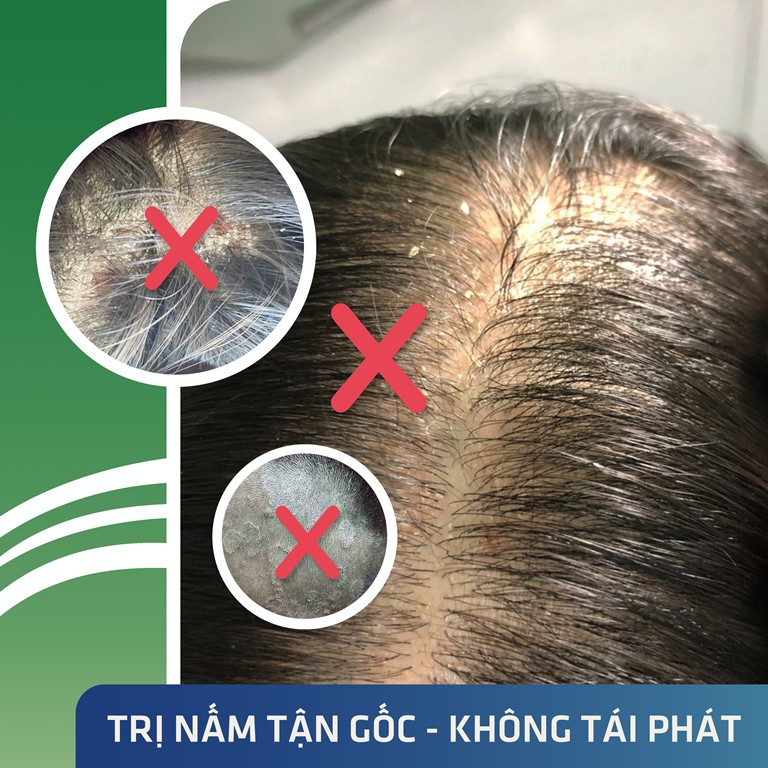 Chống Rụng Tóc, Ngăn Ngừa Nấm Da Đầu Với Dermato 200 - Chai 240ml - Chiết Xuất Dược Liệu - Thương Hiệu iCare Pharma