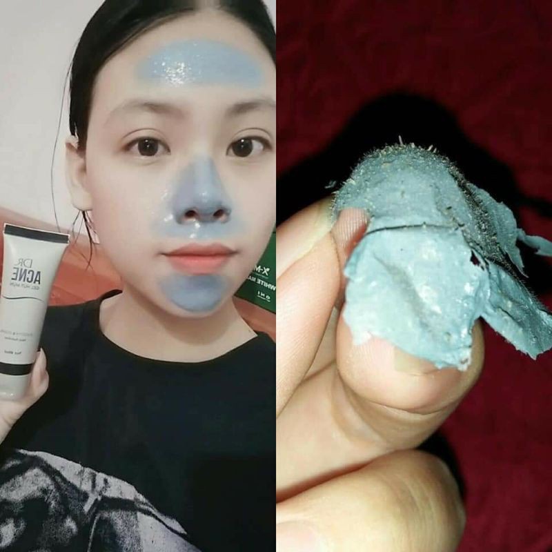 Gel Lột Mụn Hút Mụn DR.ACNE  - Giúp Thải Độc Chì - Làm Sạch Và Sáng Mịn Da