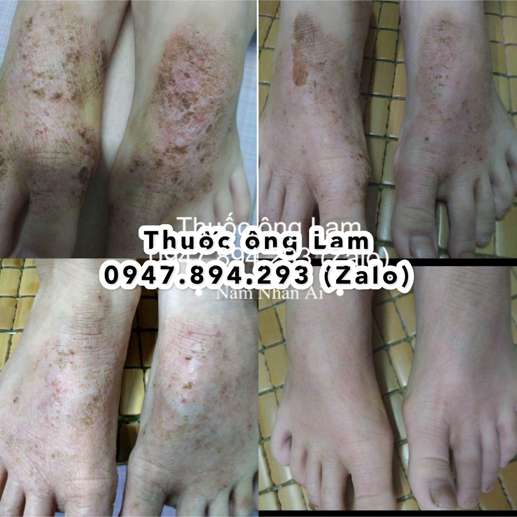Tổ đỉa, chàm, chàm sữa, mẩn ngứa, cơ địa Ông Lam | BigBuy360 - bigbuy360.vn