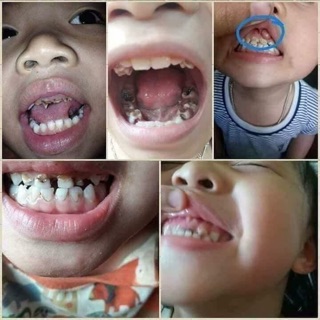 Kem đánh trắng răng