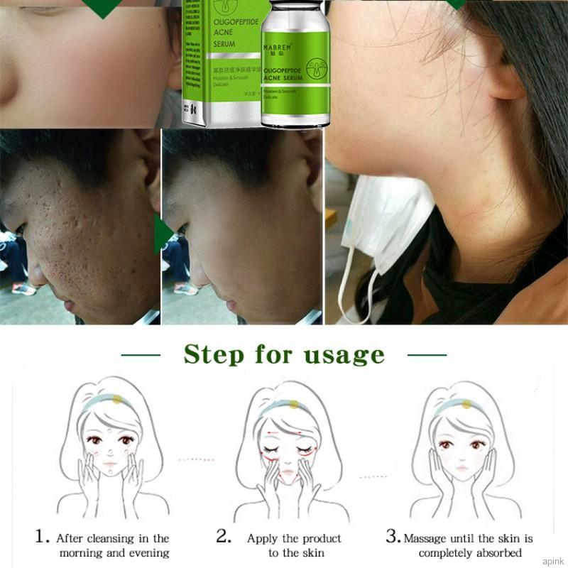 [Hàng mới về] Tinh Chất Oligopeptide Giảm Mụn Dưỡng Ẩm Làm Mịn Da Hiệu Quả