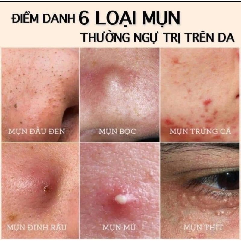 Tinh chất giảm mụn AC BAC serum, thần dược 30ML