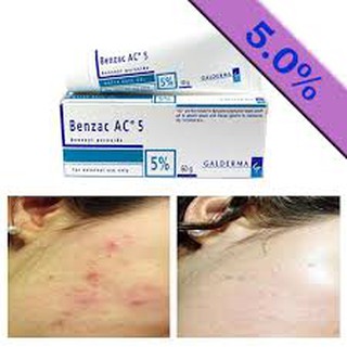 TRỊ MỤN VIÊM BENZAC 5 ( BENZOYL PEROXIDE )