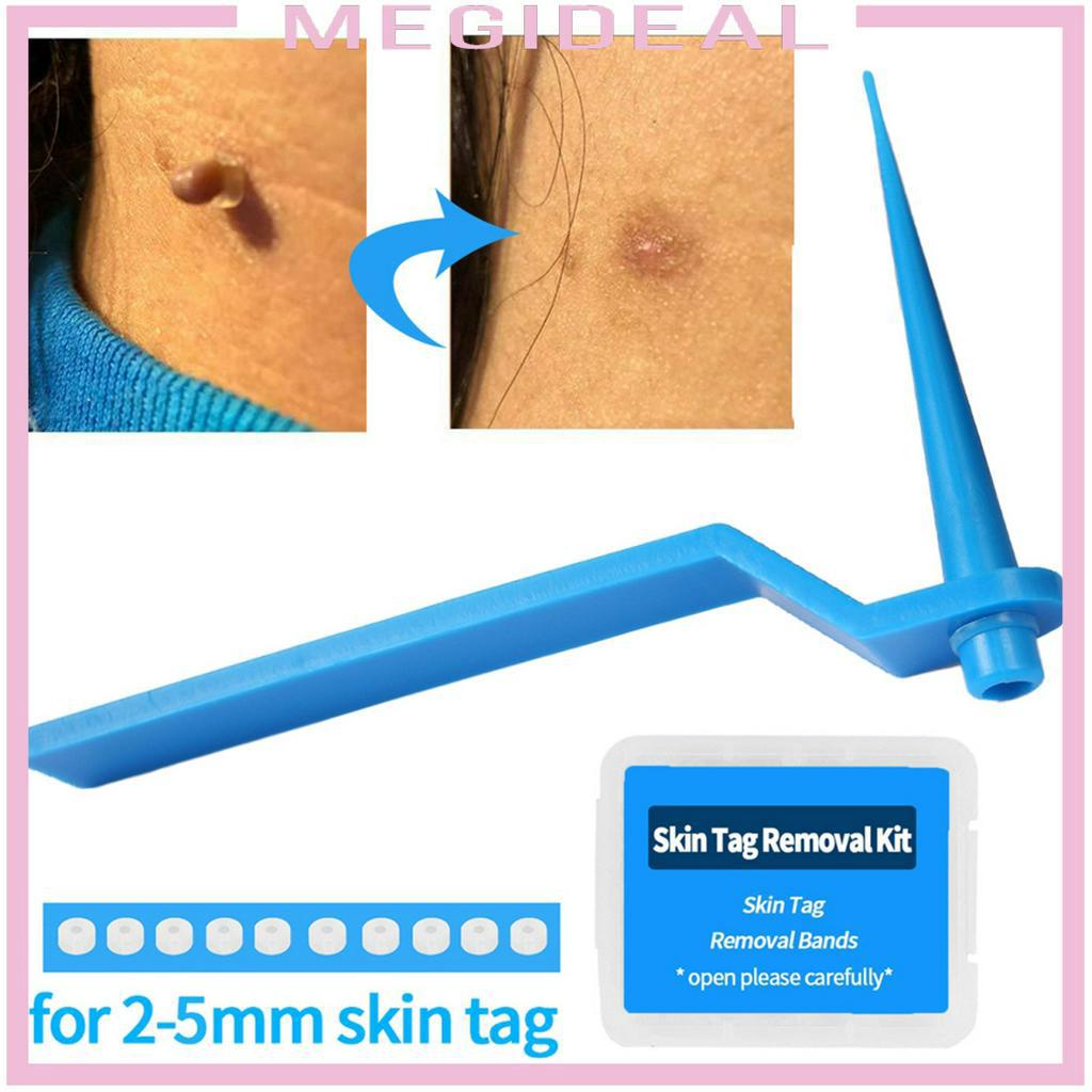 Bộ dụng cụ loại bỏ mụn thịt thừa trên làn da tiện lợi