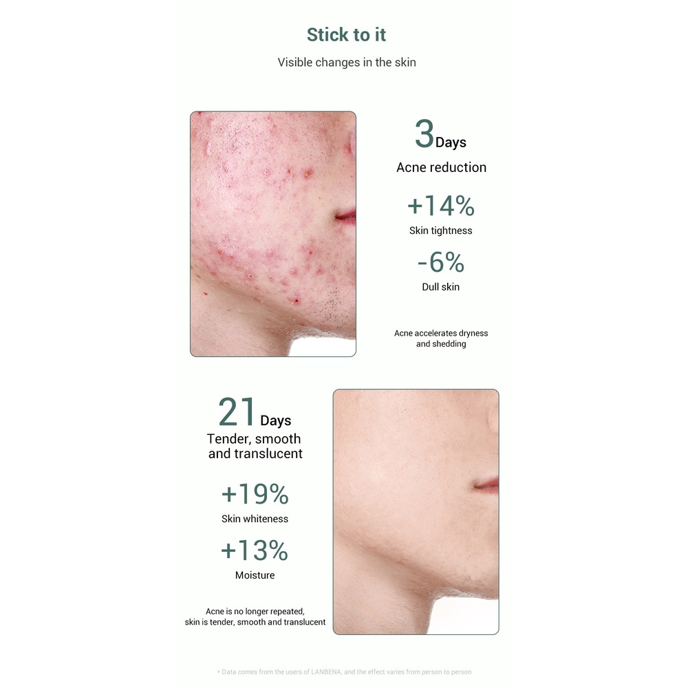 Serum hỗ trợ trị Mụn Trứng Cá Oilgopeptide LANBENA 30ml Giảm Vết Thâm Thu Nhỏ Lỗ Chân Lông Tăng Cường Và Phục Hồi Sâu