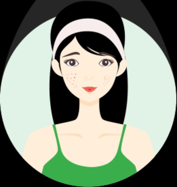 Gel làm mờ sẹo mụn và thâm mụn Hiruscar post acne