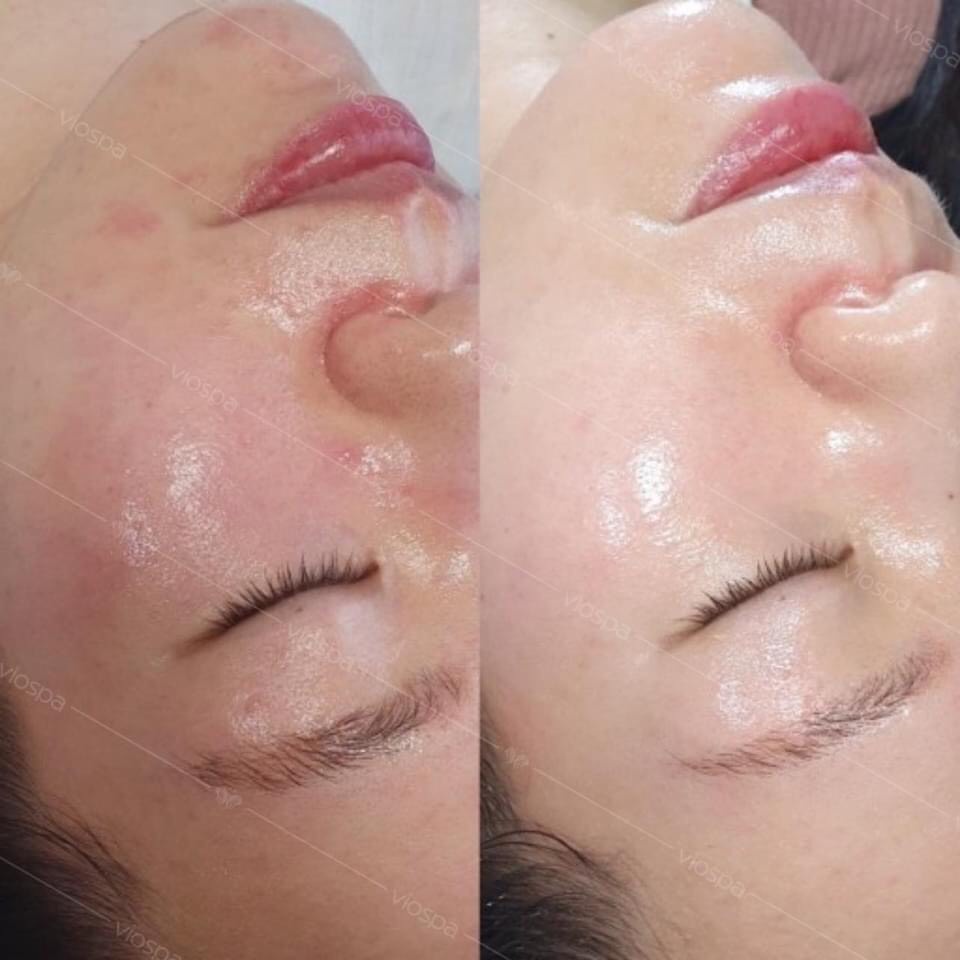 Kem phục hồi B5 Panthenol SILISCA- Dành cho da sau peel và xâm lấn