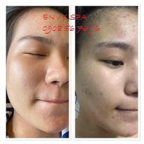 VOUCHER LẤY NHÂN MỤN + THẢI ĐỘC CHÌ - KIỀM DẦU - GIÚP DA TRẮNG SÁNG, MỜ THÂM TẠI ENVY SPA