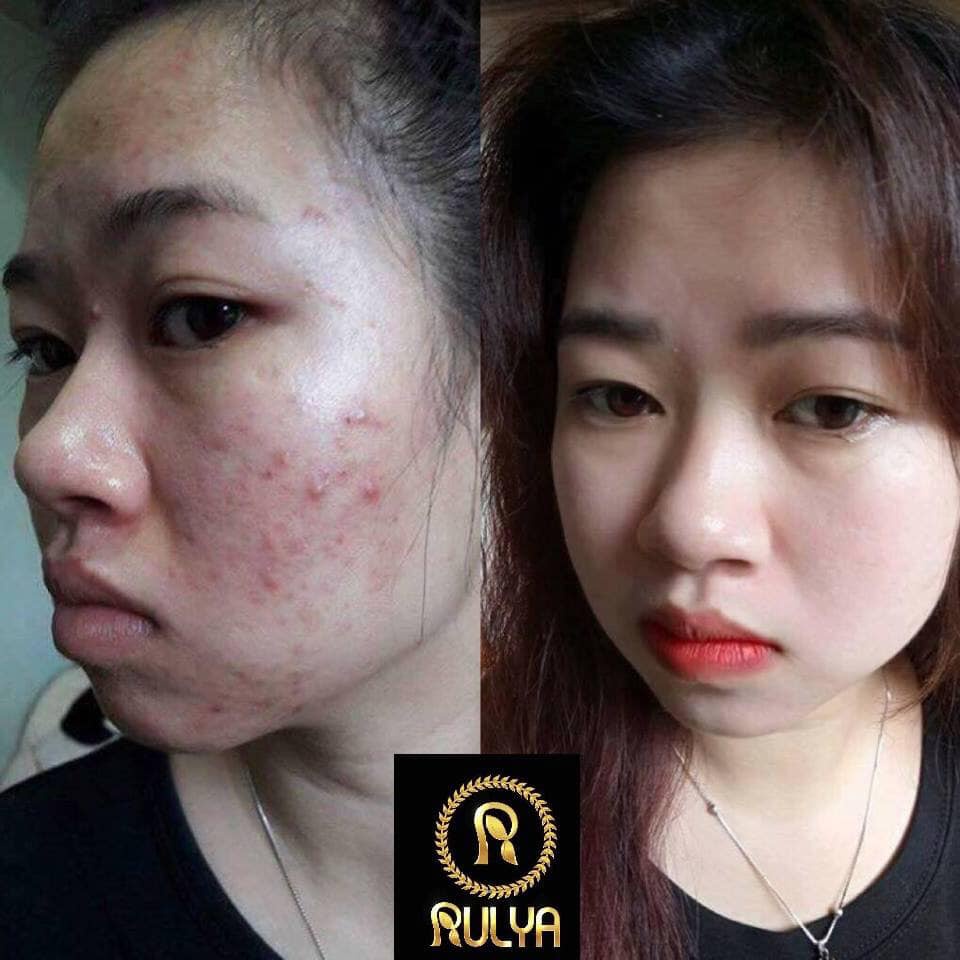 Serum Ngừa Mụn Chính Hãng Rulya Anti Acne - Hết Mụn Trong 7 Ngày | BigBuy360 - bigbuy360.vn