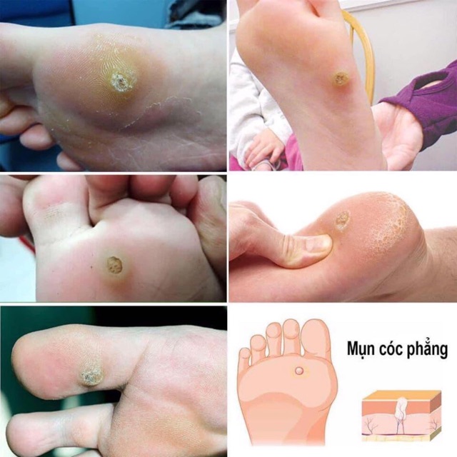 Miếng dán ch ữa mụn cóc Dr. Scholl’s Clear Ây  Wart Remover Plantar và CompoundW - Mỹ