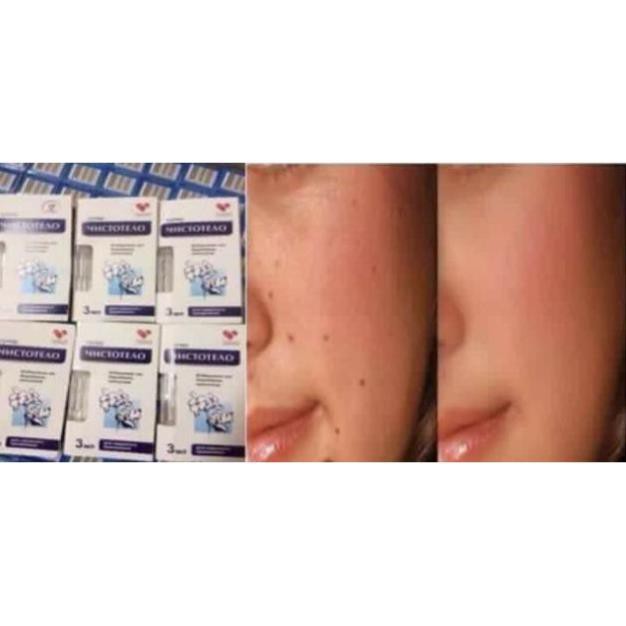 (Chuyên sỉ) Gel tẩy nốt ruồi, mụn thịt, mục cóc nga (hàng sịn) | BigBuy360 - bigbuy360.vn