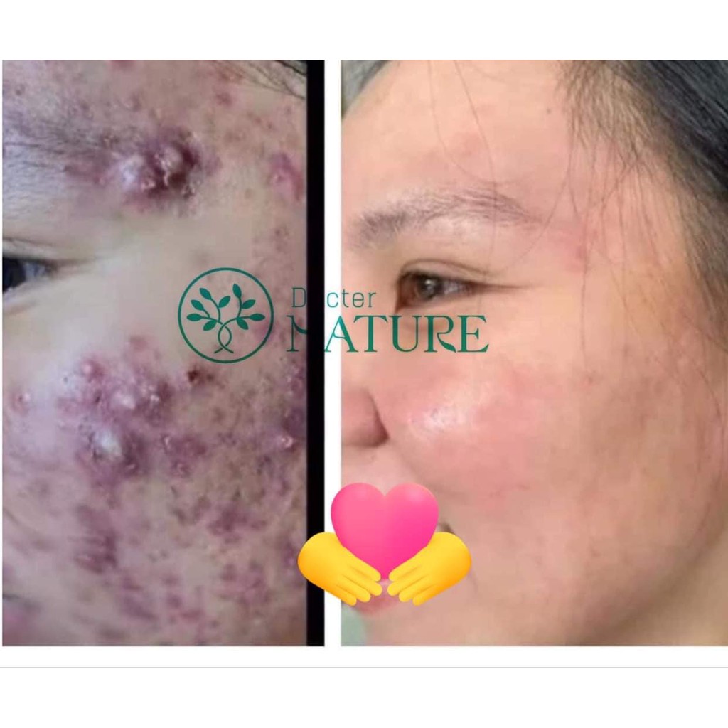 SERUM MỤN ACNES DR.NATURE-