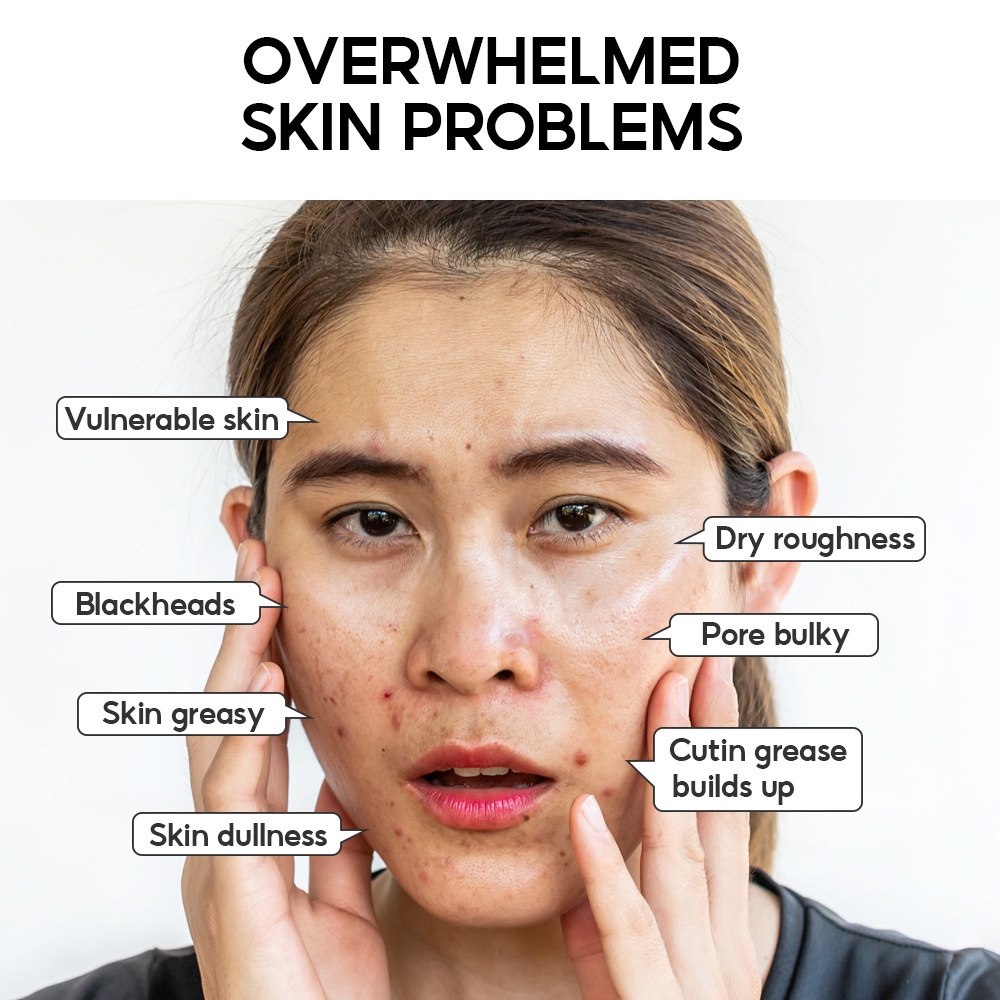 Mặt Nạ Hỗ Trợ Giảm Mụn Đầu Đen Dưỡng Ẩm Thu Nhỏ Lỗ Chân Lông
