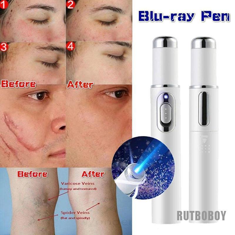 Bút laser chiếu tia xanh liệu pháp tẩy mụn/tàn nhang