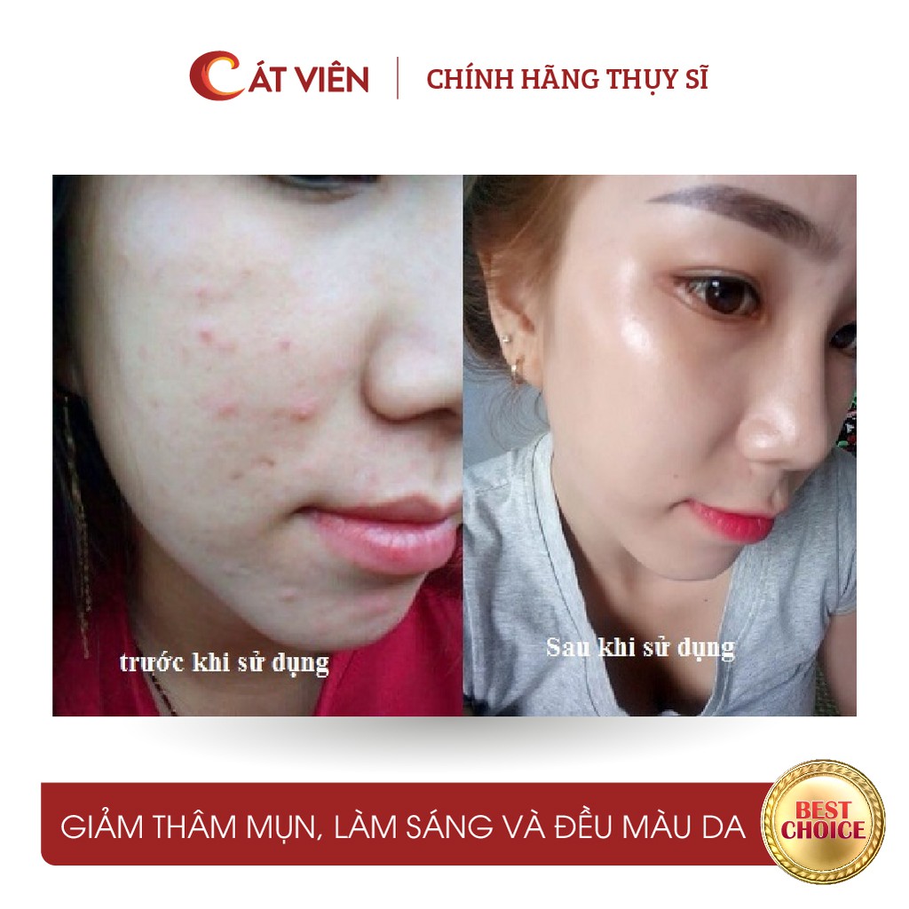 Serum mụn Derma, giảm mụn, giảm thâm,  mụn đầu đen, se khít lỗ chân lông Me'dream ACNES SERUM 50ml | BigBuy360 - bigbuy360.vn