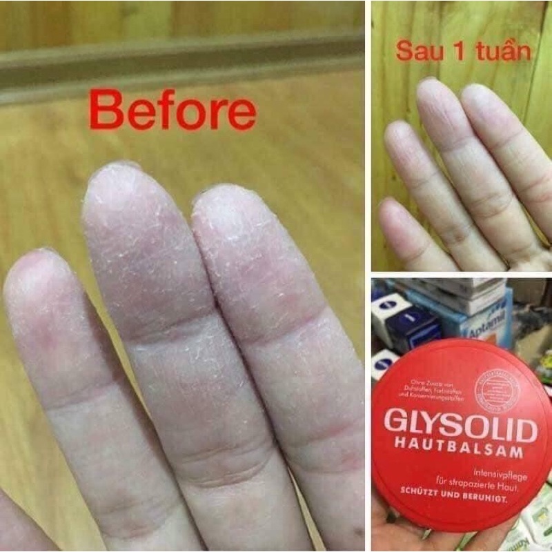 Kem dưỡng da ⚡ CHUẨN NỘI ĐỊA ĐỨC ⚡ Kem dưỡng da chân tay Glysolid Đức