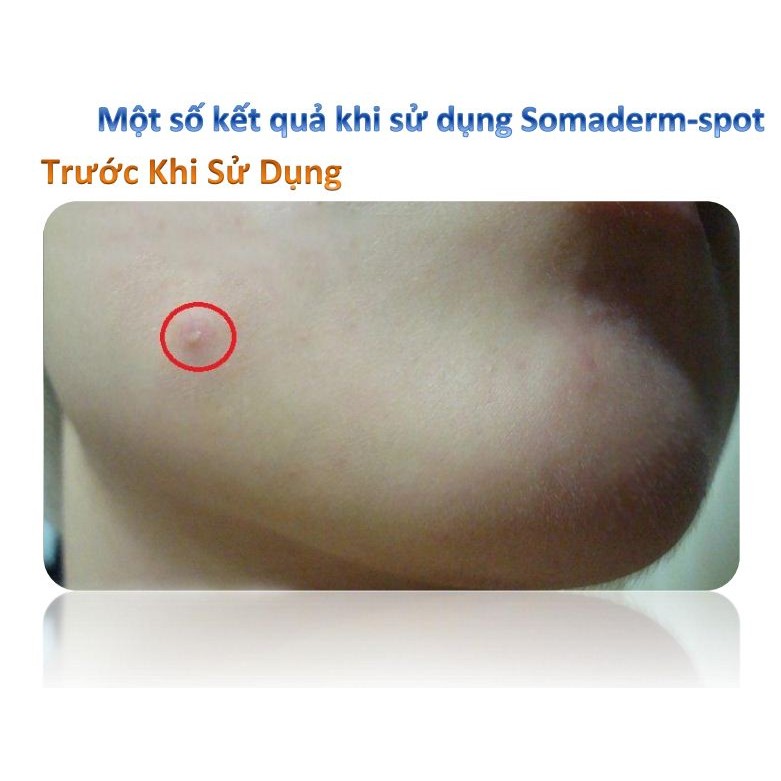 Miếng dán mụn hydrocolloid Somaderm Spot Pimple Patch 24 miếng 3 kích cỡ - MẪU MỚI HỘP XANH