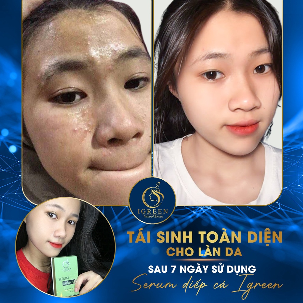 SERUM SẠCH MỤN HOÀN TOÀN - SERUM DIẾP CÁ IGREEN - BAY MỤN, THÂM, RỖ 10gr