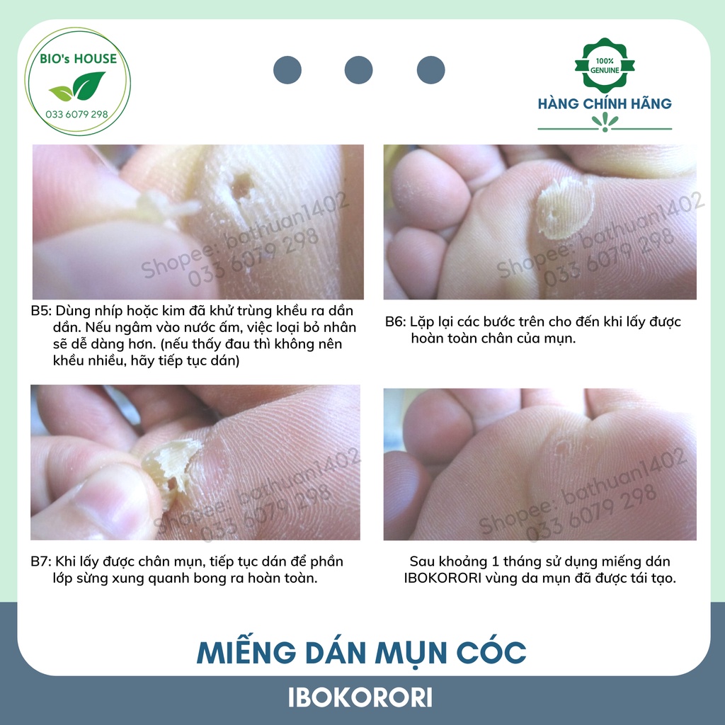 Miếng dán mụn cóc IBOKORORI 12 miếng (Nhật Bản)