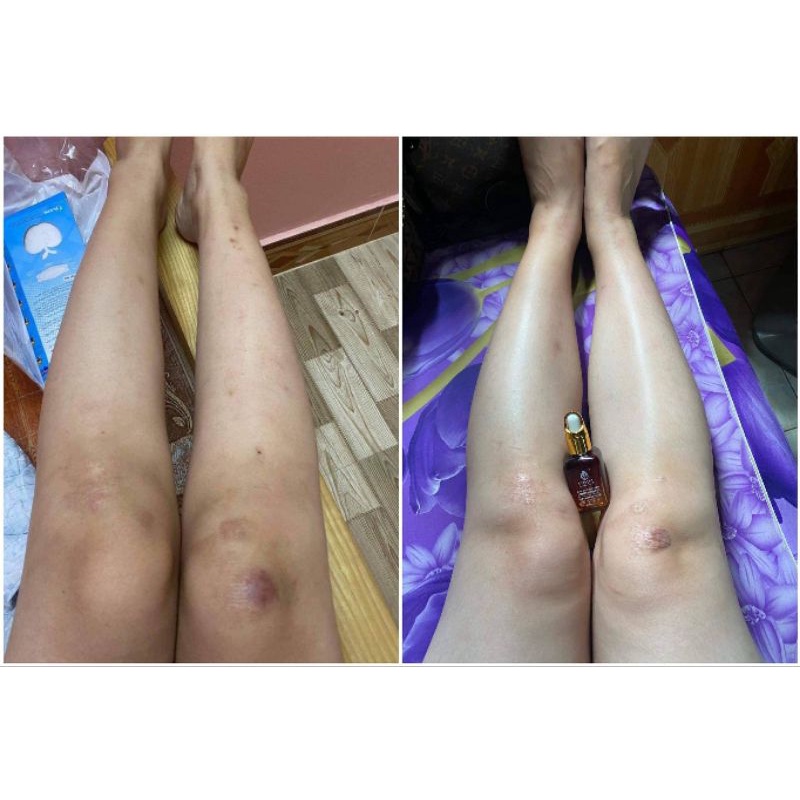 Tinh chất Xóa mờ thâm Minh Khang- Xoá thâm Sẹo,thâm mắt, thâm môi,thâm nách,thâm mụn,thâm gãi ngứa - Chính Hãng