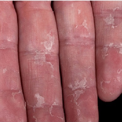 THẢO DƯỢC HẾT BAY BONG TRÓC DA NGÓN TAY, LÒNG BÀN TAY, BÀN CHÂN