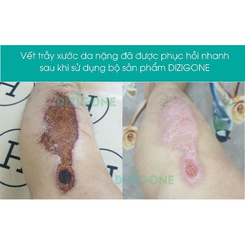 Bộ đôi Dizigone Spray 100ml và Dizigone nano bạc 25g bạc Kháng khuẩn lành vết thương tái tạo da ngăn ngừa sẹo