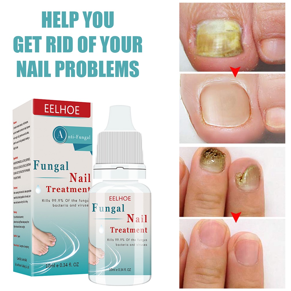 Eelhoe 10ml Nail sửa chữa nuôi dưỡng giữ ẩm chống-barb nấm giải pháp chăm sóc