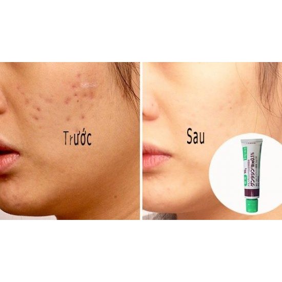 Kem Mờ Sẹo Gentacin Của Nhật Bản 10gr Làm Mờ Vết Sẹo, Giảm Thâm, Ngăn Ngừa Mụn