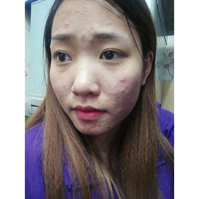 [SIÊU TRỊ MỤN-CHÍNH HÃNG100%] Serum Mụn AMOLI CENLY Đánh Bay Mụn Trong 2-3 Ngày | BigBuy360 - bigbuy360.vn