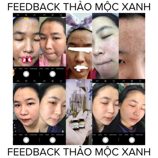 2 serum tmx & 1 serum tmx x5 ( 3 lọ)