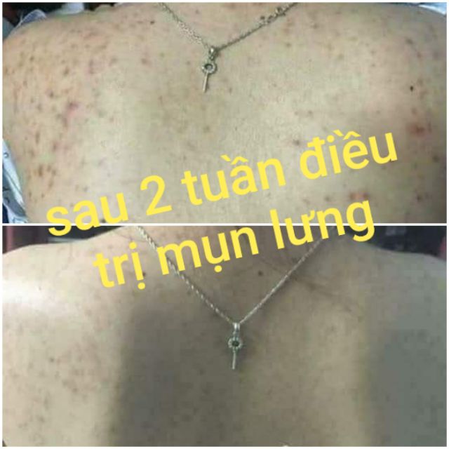 MỤN LƯNG