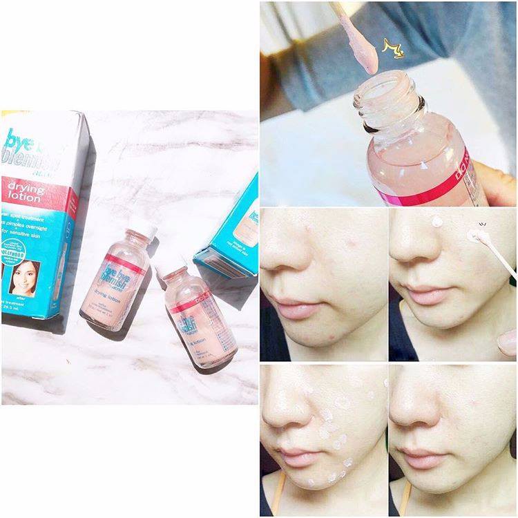 Lotion Dạng Chấm Bye Bye Blemish Dryting - Mẫu Mới